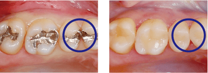 奥歯の治療例